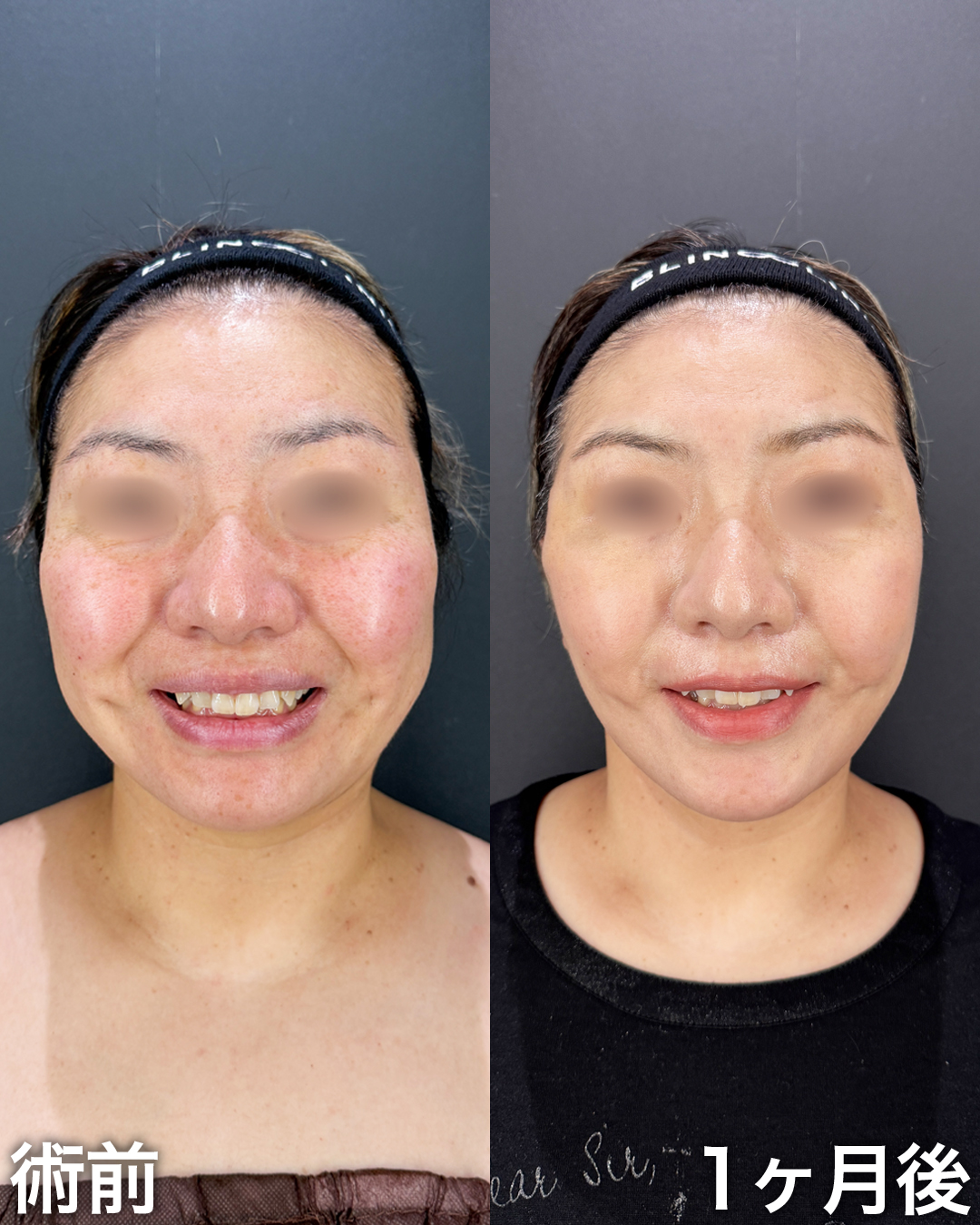 40代の方：切開リフト(Deep Plane Face Lift )・切開ネックリフト・脂肪吸引(顎下・ジョールファット)
