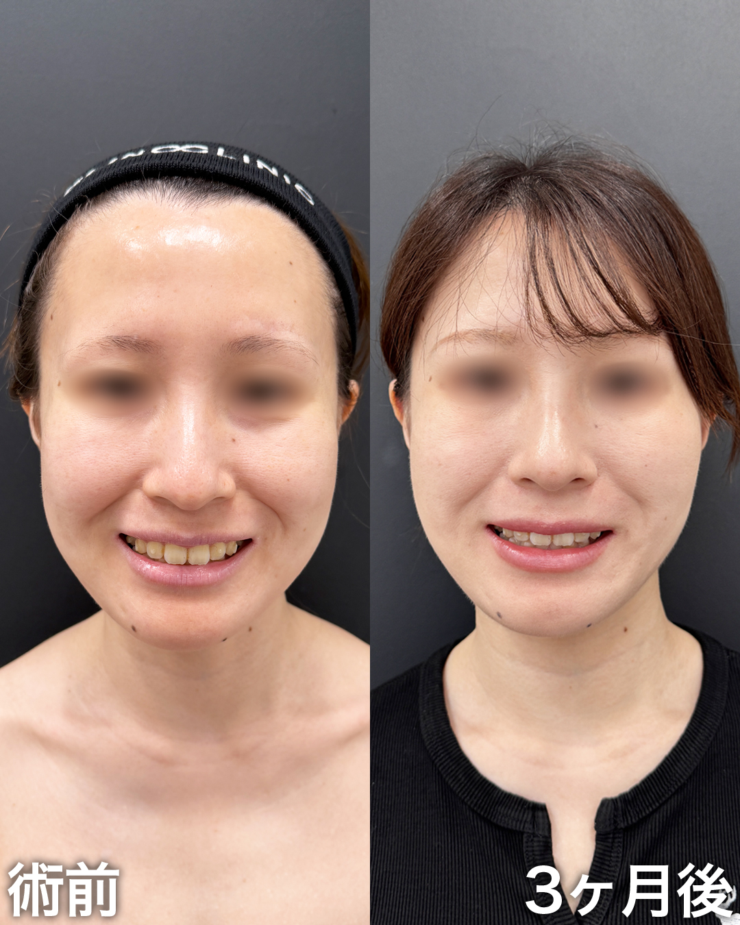 20代の方：ミッドチークバックリフト®︎・脂肪吸引(ジョールファット)・糸リフト