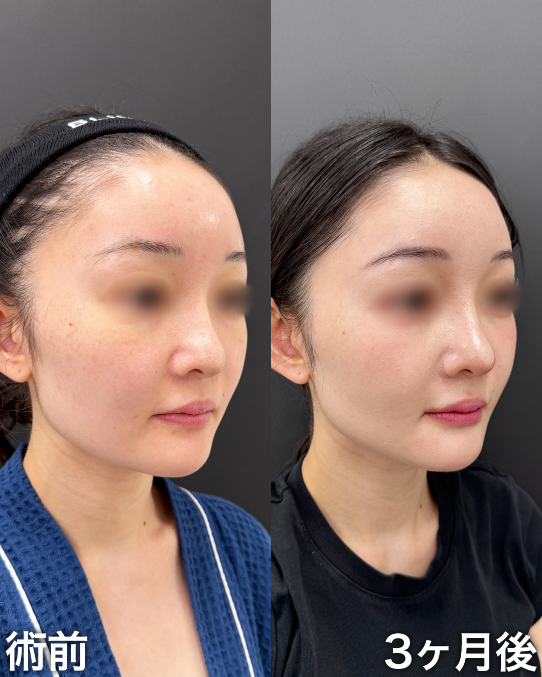 30代の方：脂肪吸引(ジョールファット)・糸リフト