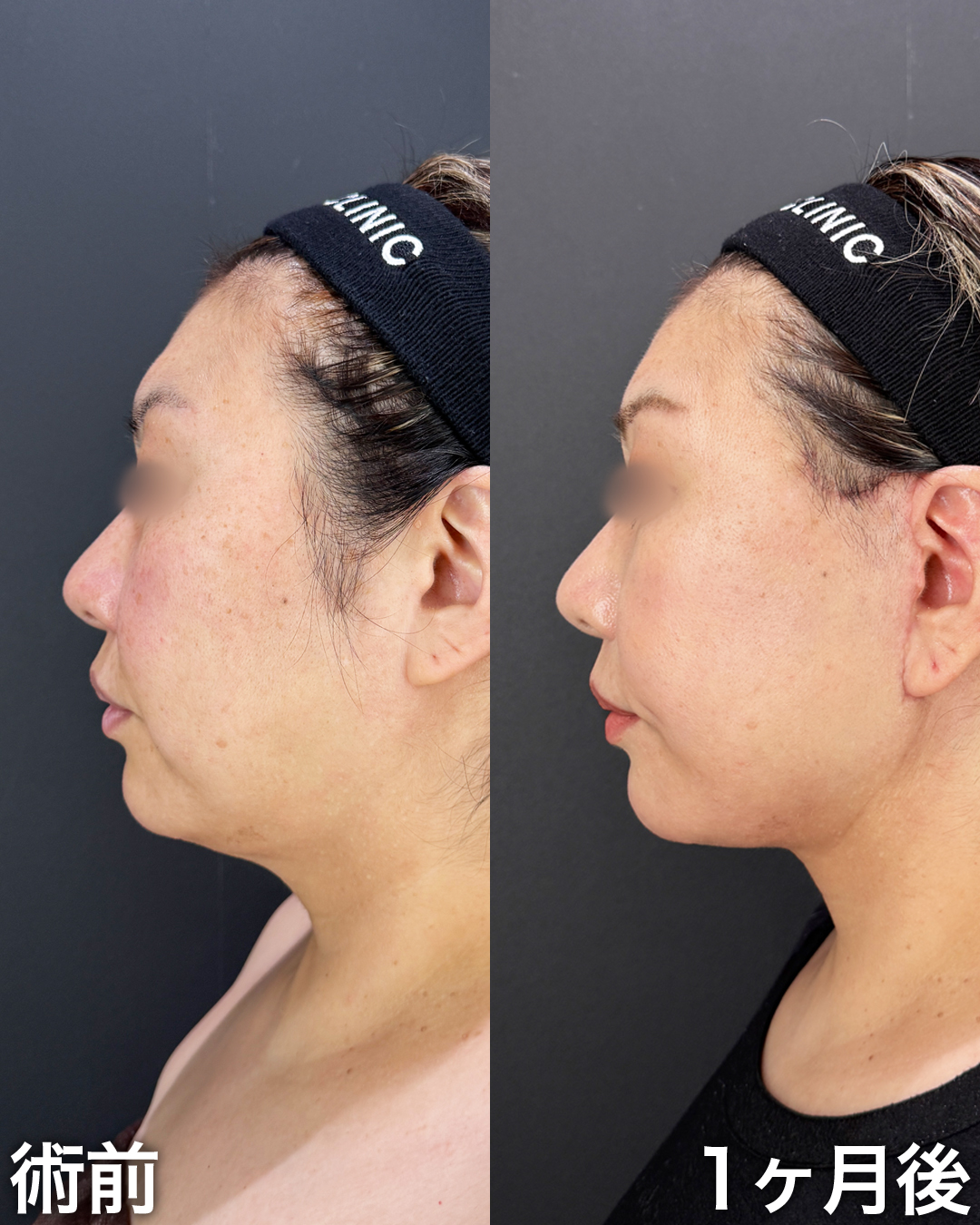 40代の方：切開リフト(Deep Plane Face Lift )・切開ネックリフト・脂肪吸引(顎下・ジョールファット)