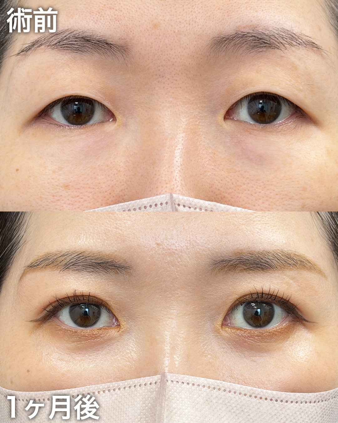 30代の方：二重埋没・まぶたの脂肪取り・目の下のクマとり