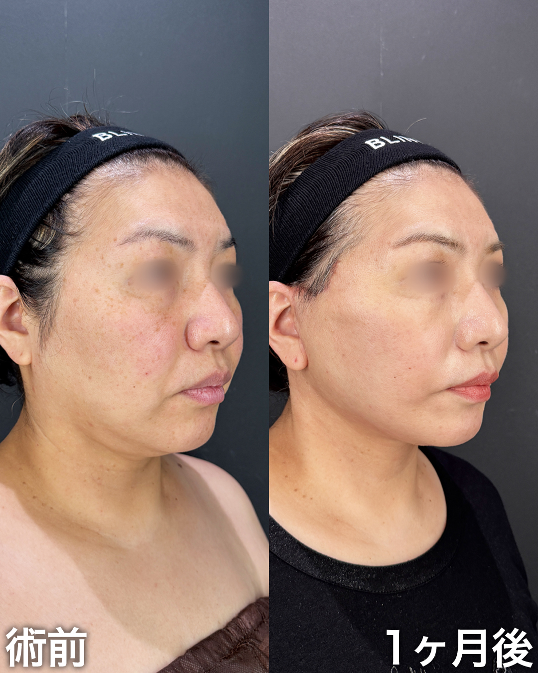 40代の方：切開リフト(Deep Plane Face Lift )・切開ネックリフト・脂肪吸引(顎下・ジョールファット)