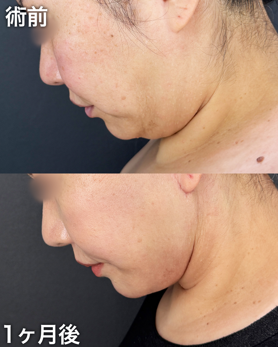 40代の方：切開リフト(Deep Plane Face Lift )・切開ネックリフト・脂肪吸引(顎下・ジョールファット)